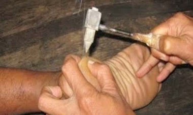 अग्निकर्म अखिल भारतीय आयुर्वेद संस्थान का चमत्कार